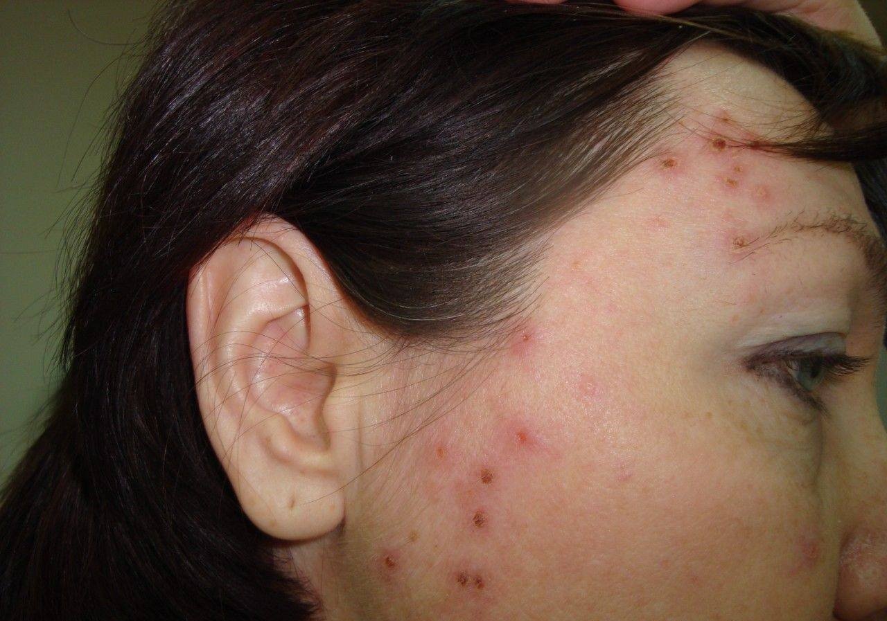Neden yüzünde pigment lekeleri var: En olası nedenler Neden yüzünde pigment lekeleri var: En olası nedenler