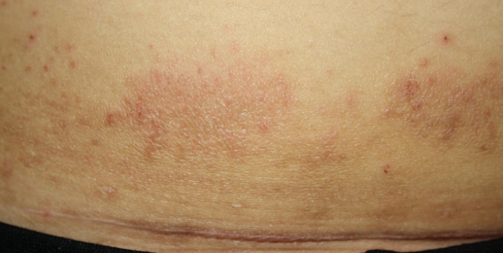 Mantar kasık veya inguinal dermatomikozda 31